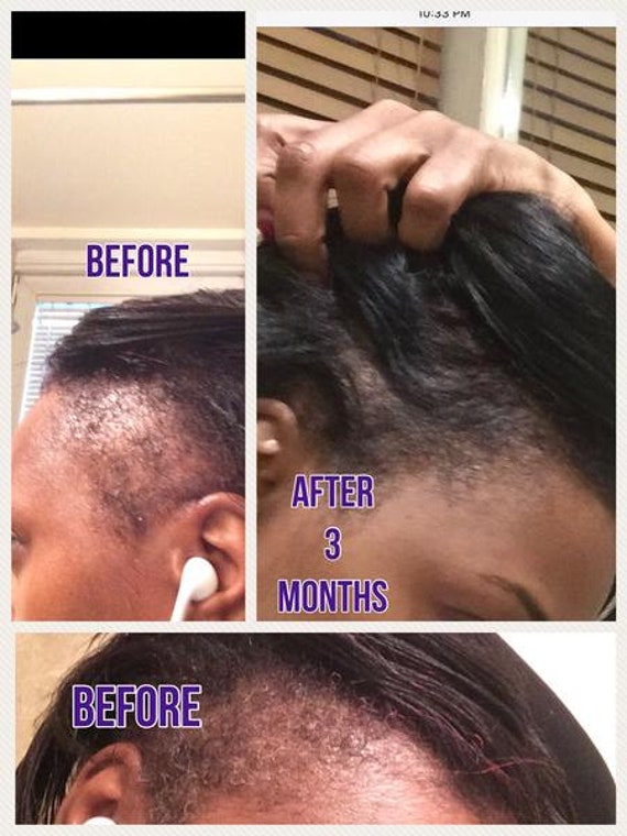 Natural Hair Growth Kit Large Size Mega Growth Hair Elixir Etsy