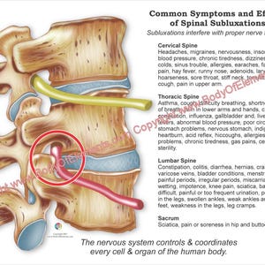 Veelvoorkomende effecten van spinale subluxatie chiropractie poster hand-out digitale download afdrukbare muurkaart afdrukken cervicale thoracale lumbale zenuw