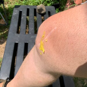 May include: A close-up of a person's knee with a yellow ointment applied to a scar. The knee is resting on a black plastic surface.