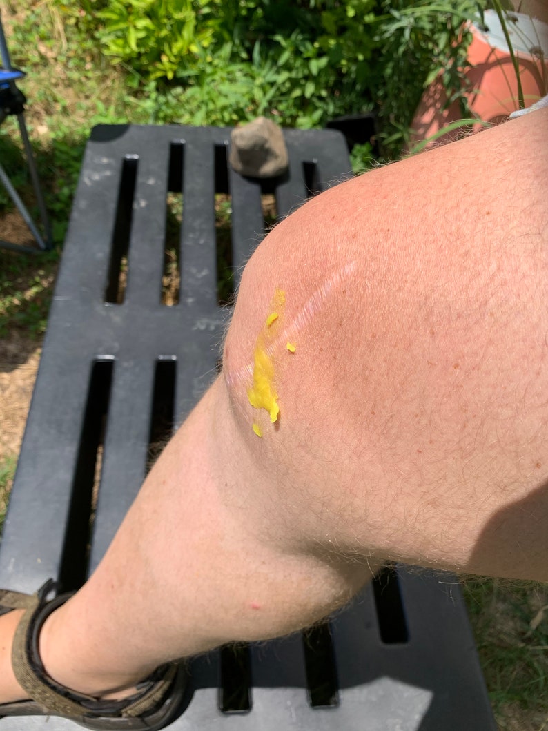 May include: A close-up of a person's knee with a yellow ointment applied to a scar. The knee is resting on a black plastic surface.