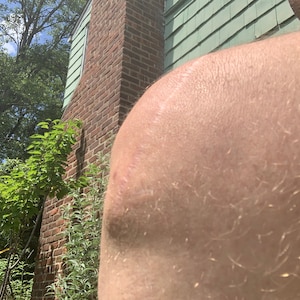 May include: Close-up of a person's arm with a long, thin scar on the skin. The arm is in front of a brick wall with green siding.