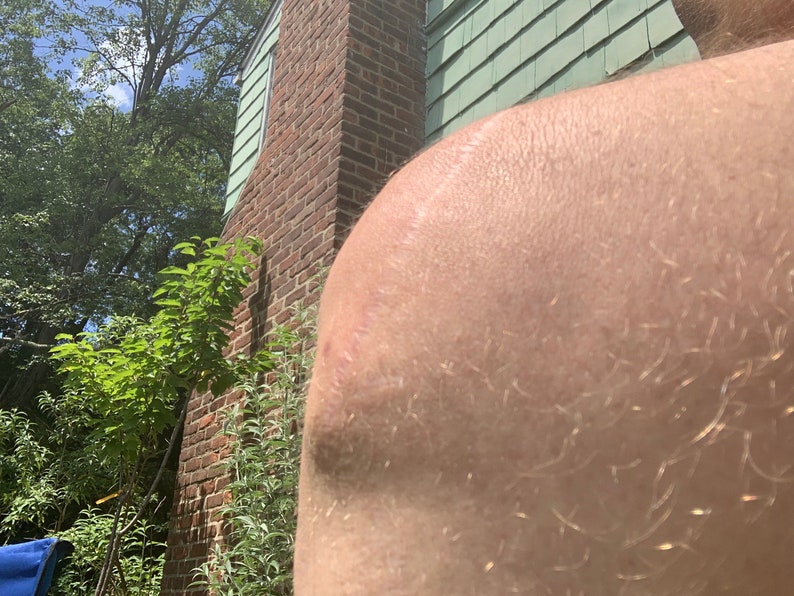 May include: Close-up of a person's arm with a long, thin scar on the skin. The arm is in front of a brick wall with green siding.