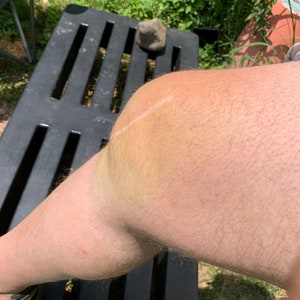 May include: A close-up of a person's leg with a scar on the knee. The knee is bruised and discolored. The leg is resting on a black plastic bench.