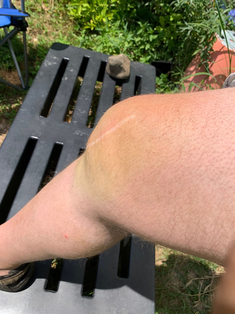May include: A close-up of a person's leg with a scar on the knee. The knee is bruised and discolored. The leg is resting on a black plastic bench.