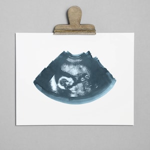 STORM Ultrasound, Sonogram, Physical Print
