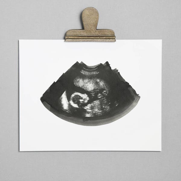 SLATE Ultrasound, Sonogram, Physical Print