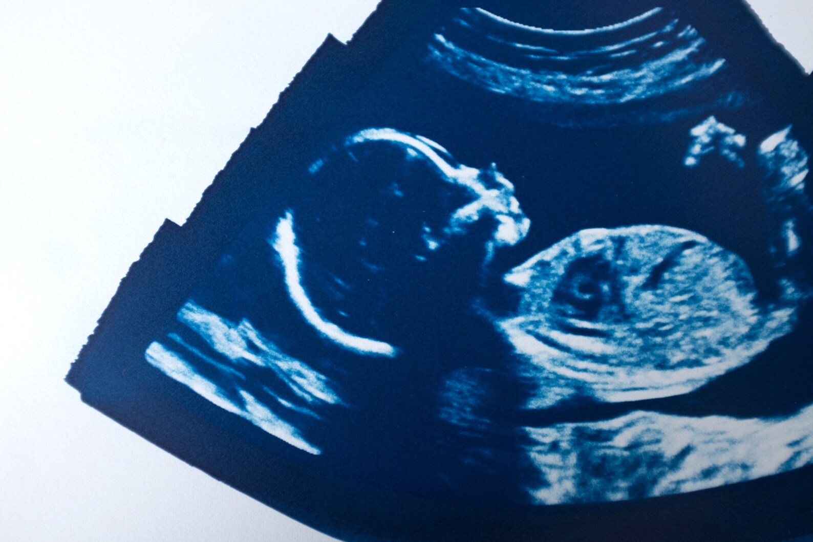Ultrasound Sonogram ORIGINAL Cyanotype Print 5x7 Etsy