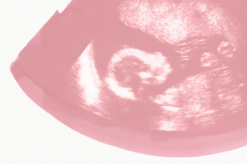 THISTLE Ultrasound, Sonogram, Physical Print image 2
