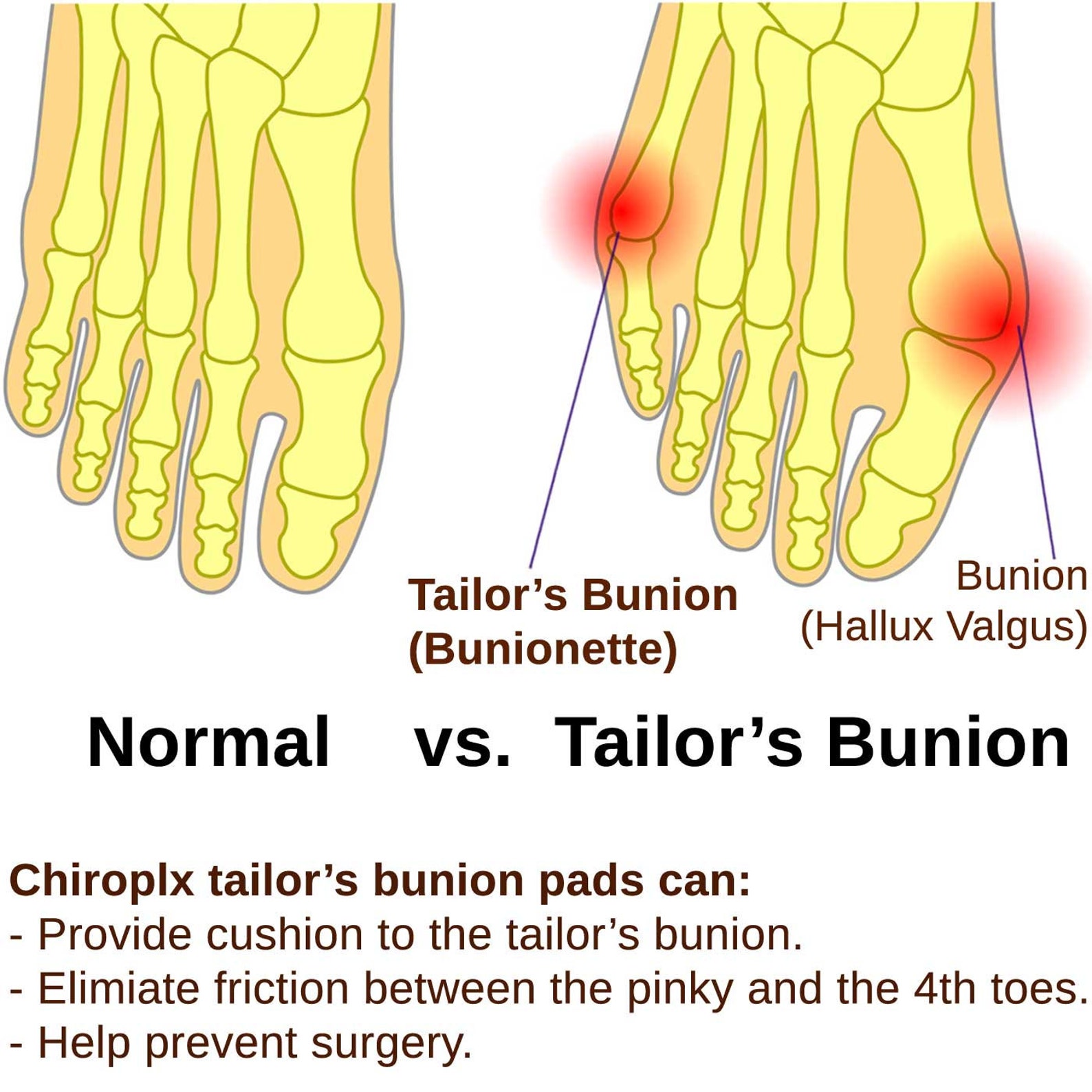 Chiroplax Tailor's Bunion Corrector Pads Pain Etsy