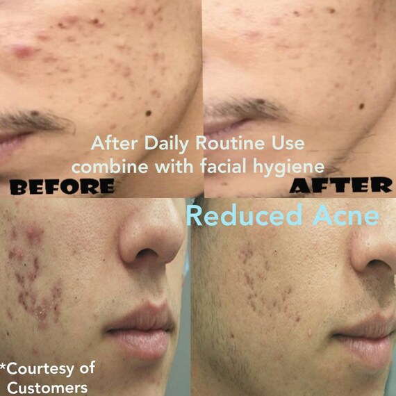 Face Acne Cream Vegan Acne Behandeling Puistje Behandeling Etsy