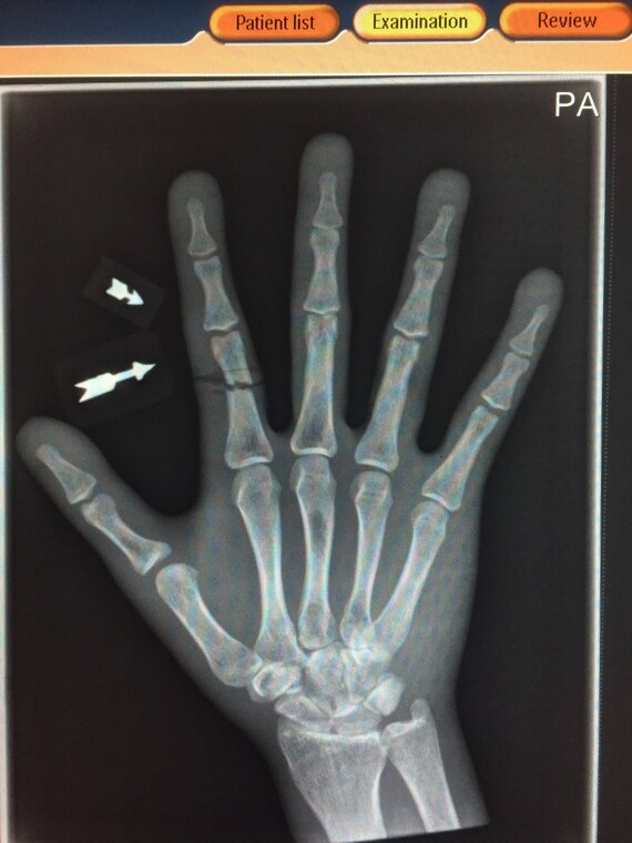 Xray Arrow Markers Radiology Markers Etsy