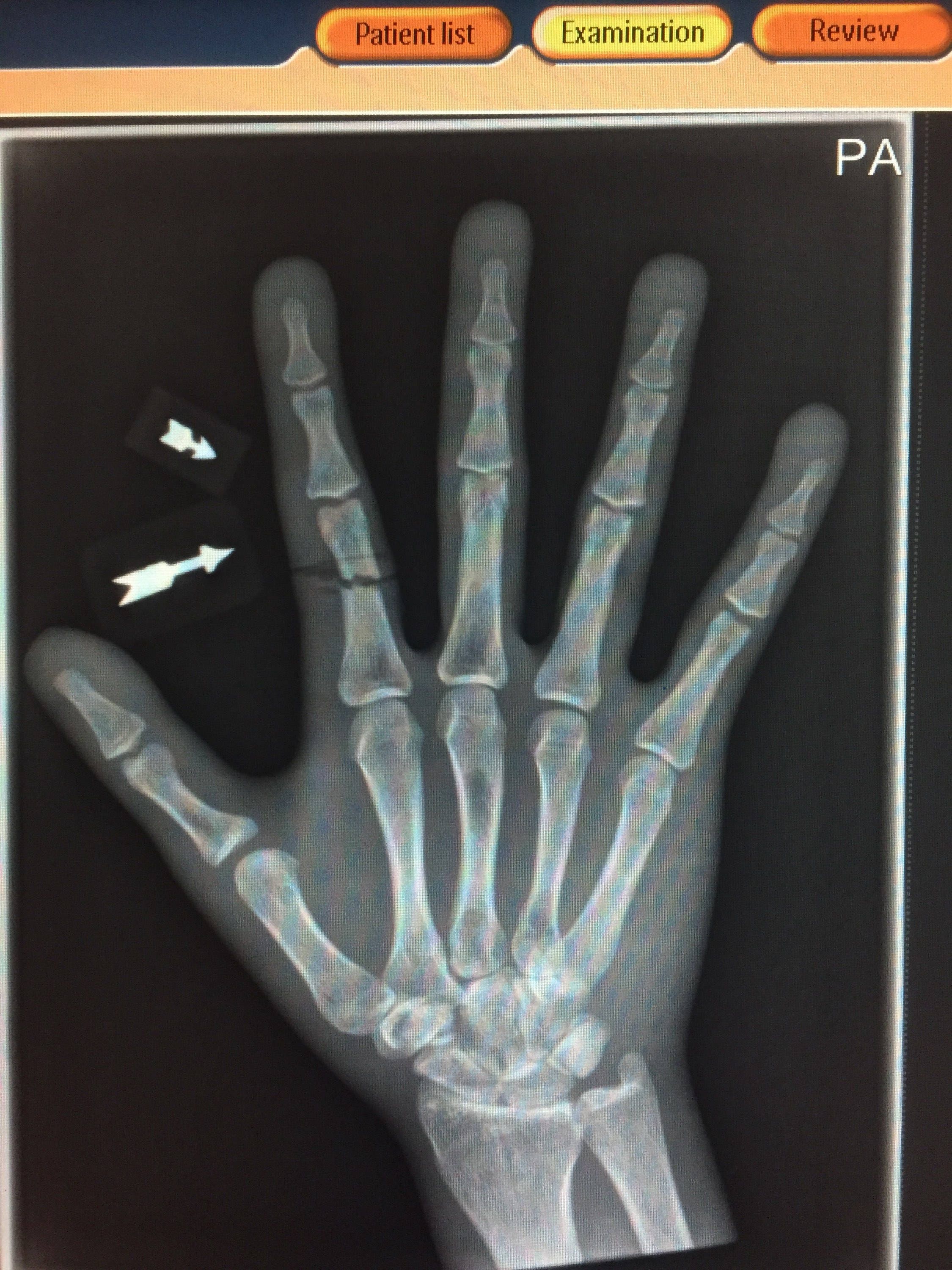 Xray Arrow Markers Radiology Markers Etsy