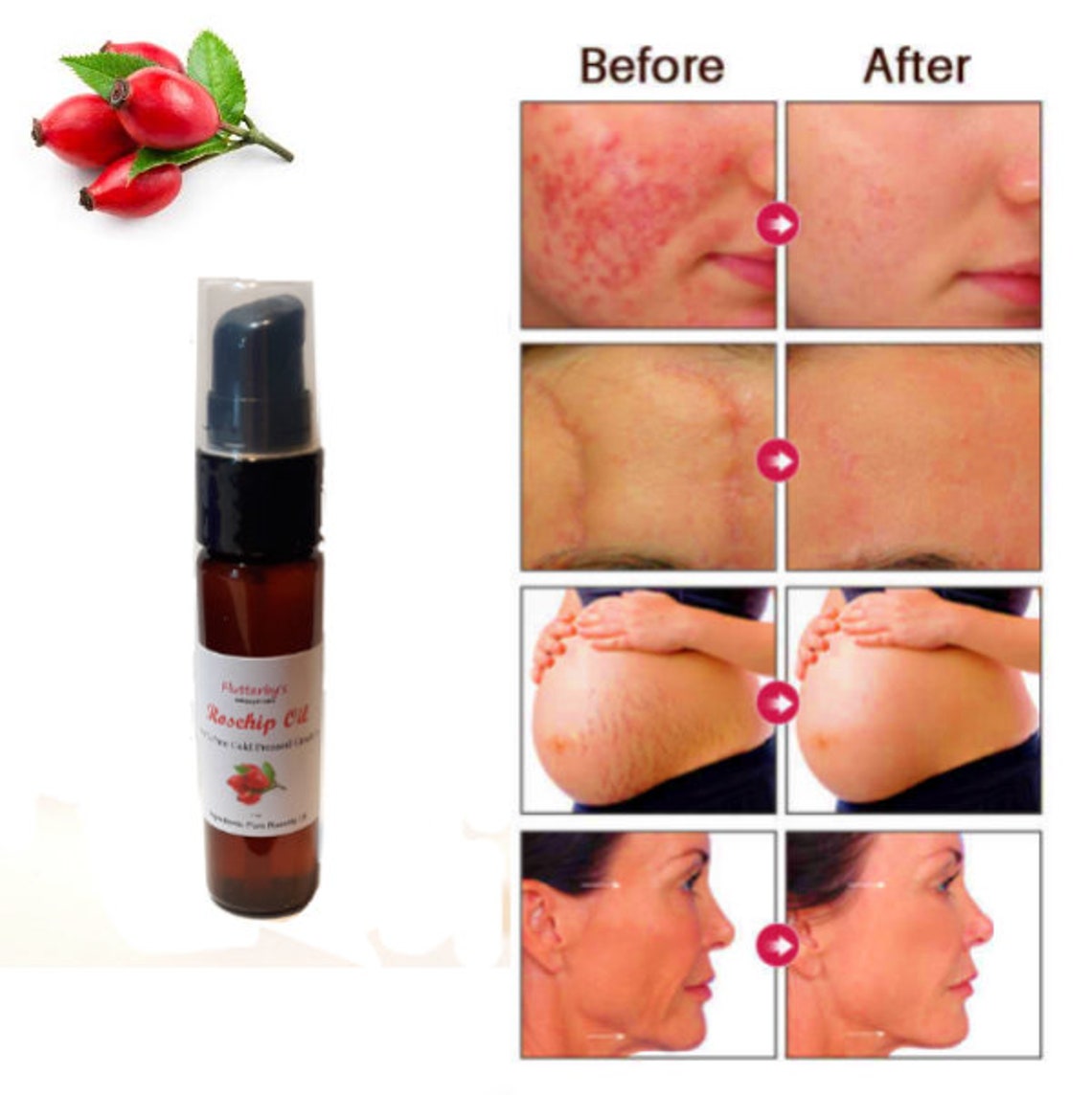 Rosehip Oil 1oz Natural Aging Scars Acne Fine Lines Stretch Etsy