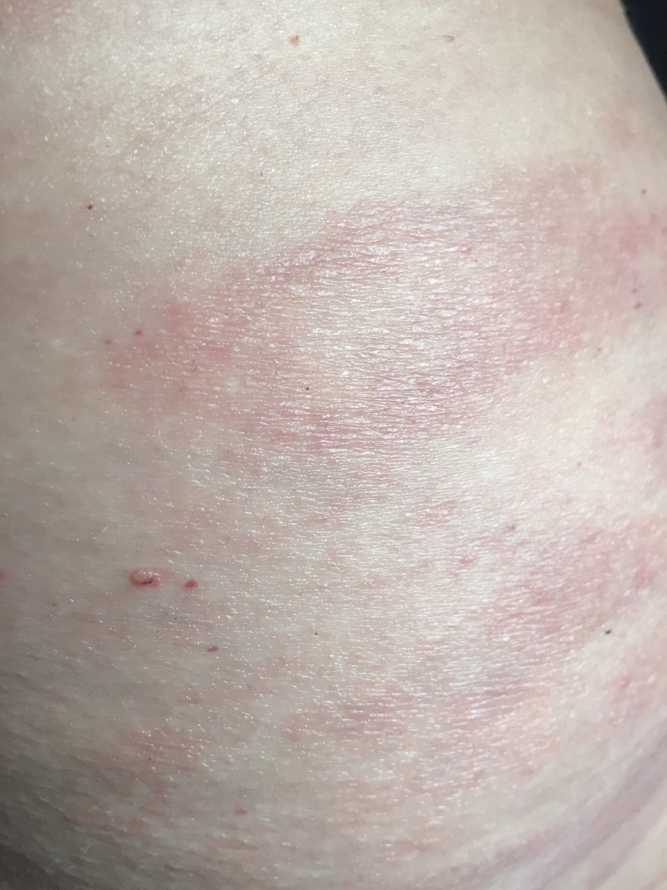 Pityriasis rosea cream, PrrEze 16 ounce all natural ease the itch, see