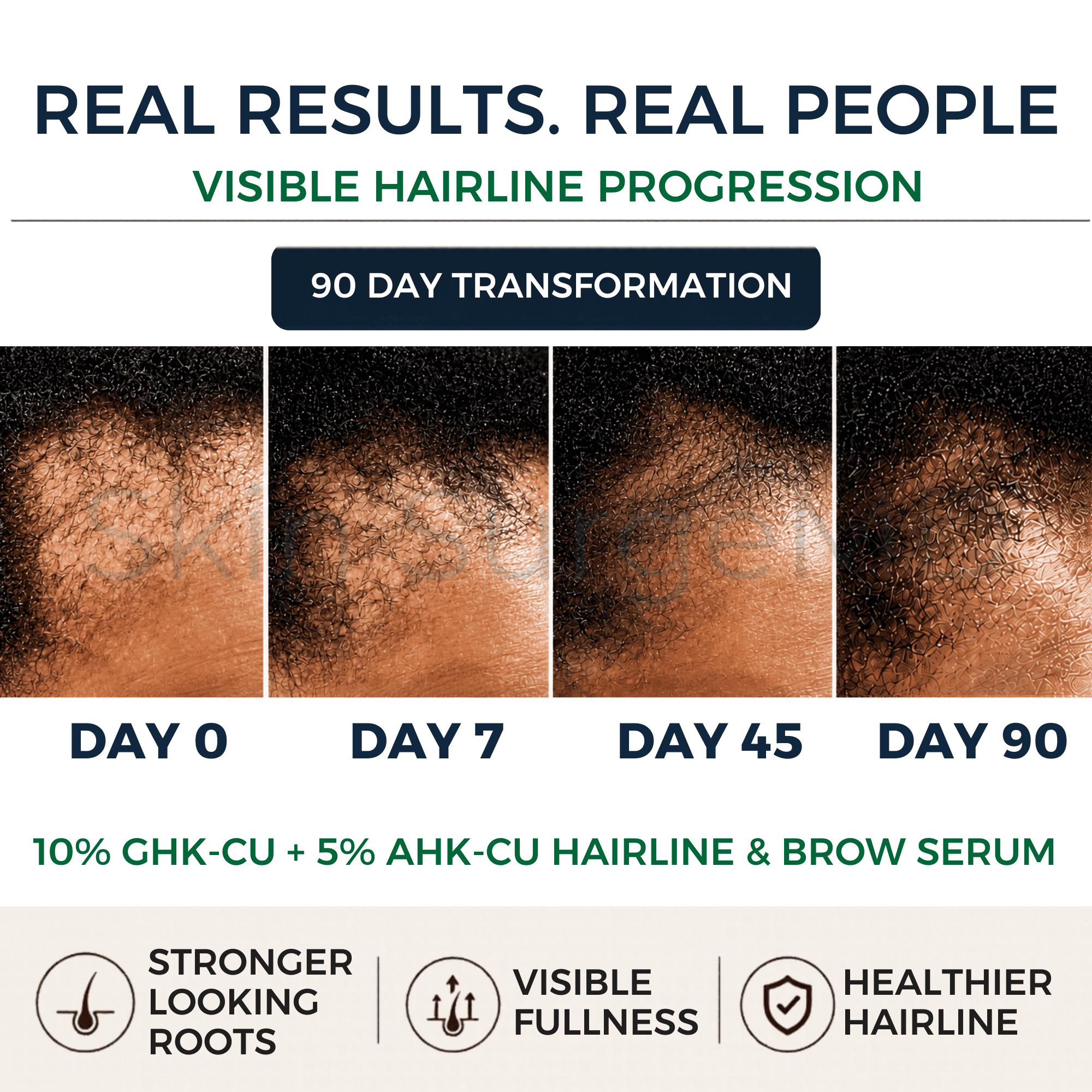 ahk cu results AHK-CU vs. GHK-CU  Neurogan Health Cu and Acetyl Tetrapeptide AHK-Cu Copper Peptide Hair Growth