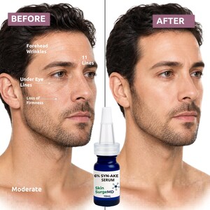 Op de afbeelding: Afbeelding die het gezicht van een man vergelijkt voor en na gebruik van een serum. De "Voor"-kant toont rimpels en verlies van stevigheid. De "Na"-kant toont een gladdere teint. Een blauwe fles "6% SYN-AKE SERUM" staat op de voorgrond.