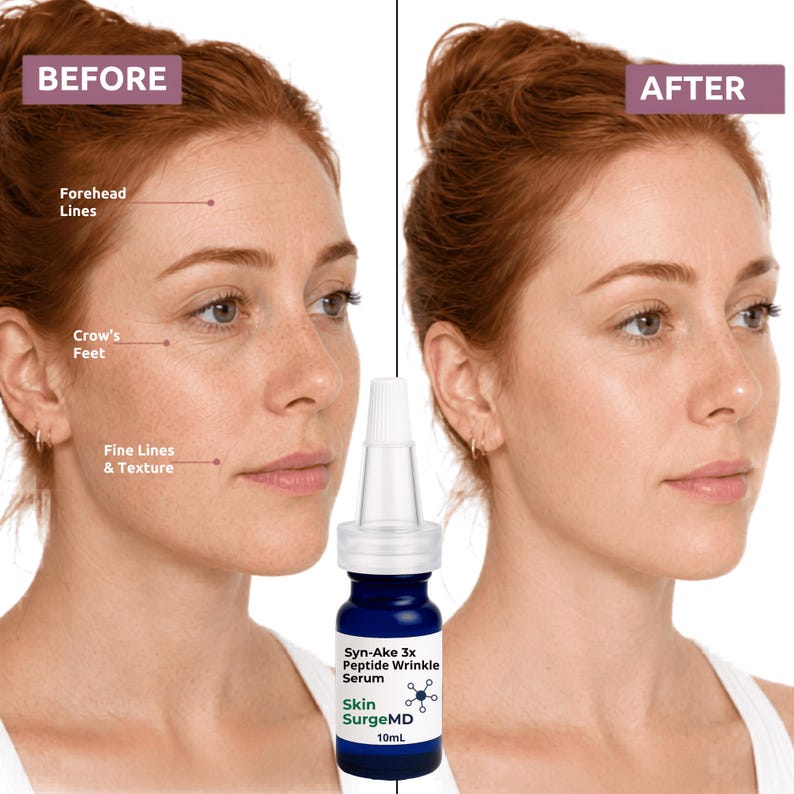Op de afbeelding: Een 10 ml blauwe glazen flesje Skin SurgeMD Syn-Ake 3x Peptide rimpelserum met een witte druppeldop, naast een gesplitst scherm met een gezicht gelabeld VOOR met zichtbare lijntjes en NA met een gladdere huid.