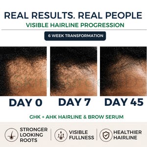 ghk cu hair growth before and after Male Hair Restoration Before & After with PRF and GHK-Cu main image 0