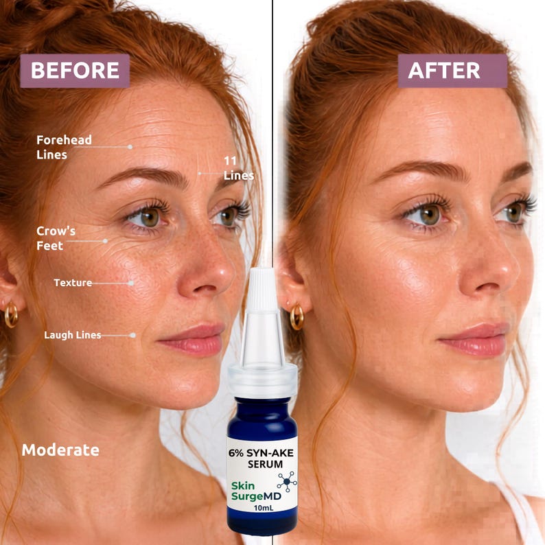 Op de afbeelding: Afbeelding die de huid vergelijkt voor en na gebruik van een serum. De "voor"-kant toont matige rimpels en textuur, met labels die wijzen op voorhoofdslijnen, kraaienpootjes en lachlijnen. De "na"-kant toont een gladdere huid. Een serumflesje staat in het midden.