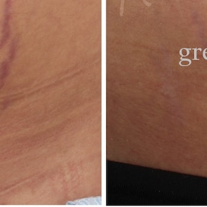 15 Pure Bioidentical Oils Blend for fresh Stretch Marks & Scars