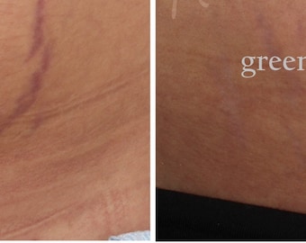 15 Pure Bioidentical Oils Blend for fresh Stretch Marks & Scars