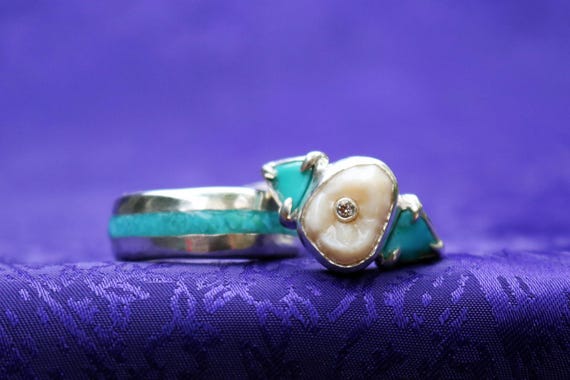 Custom Tooth Ring Consult