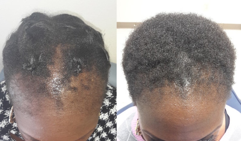 Hair Growth Oil_ Itchy Scalp Hair Loss, Hair thinning, Dandruff, Bald Spots, Indian Hair Herbs, for him, for her, image 1