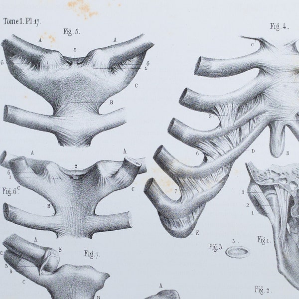 Maxillary and Thoracic Joints - RARE ORIGINAL PRINT from Atlas d'Anatomie descriptive du corps humain C. Bonamy - Paris 1866