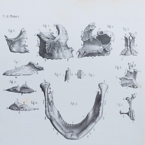 Facial Bones  - RARE ORIGINAL PRINT from Atlas d'Anatomie descriptive du corps humain C. Bonamy - Paris 1866