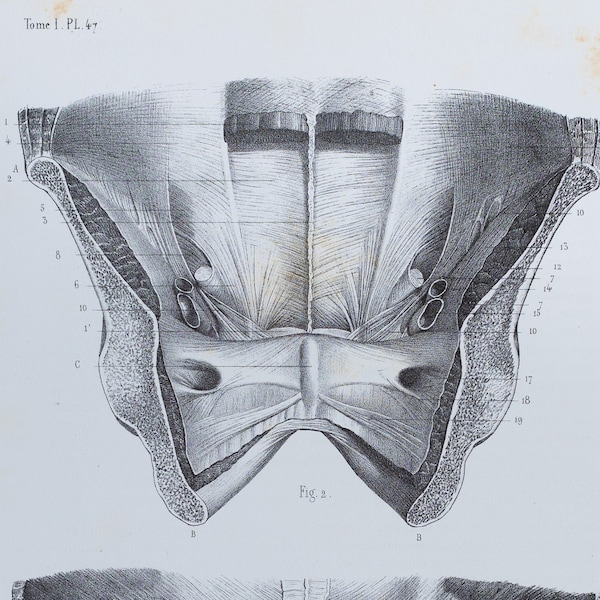 Iliac Crest Muscles - RARE ORIGINAL PRINT from Atlas d'Anatomie descriptive du corps humain C. Bonamy - Paris 1866