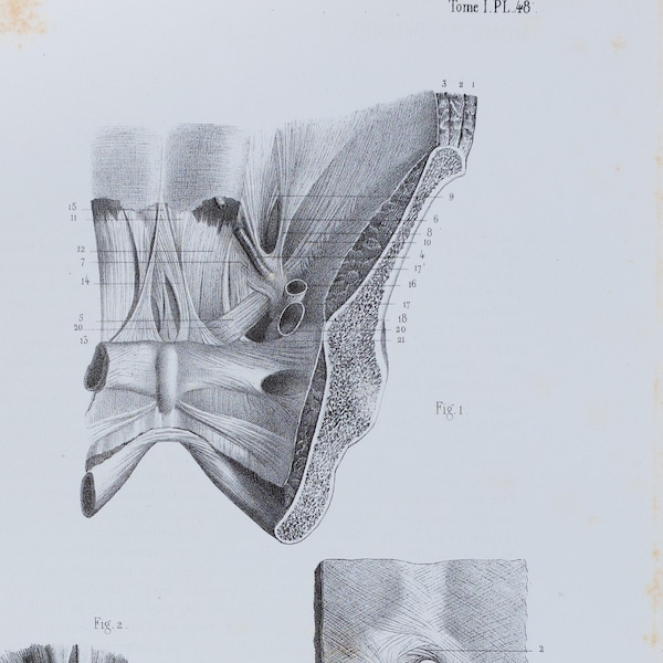 Sacrum Muscle - RARE ORIGINAL PRINT from Atlas d'Anatomie descriptive du corps humain C. Bonamy - Paris 1866