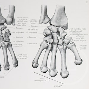 Bones of the Hand: Carpal / Lower arm bone / Human Anatomy - Descriptive Anatomy Book from 1926Printed on both sides!