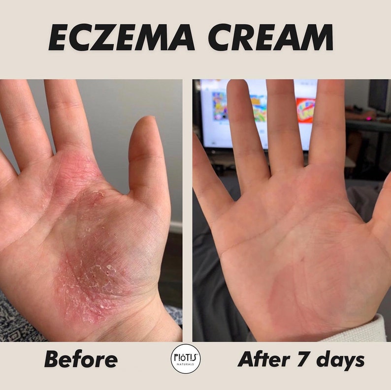 Eczema cream vegan eczema cream organic eczema dry skin Etsy