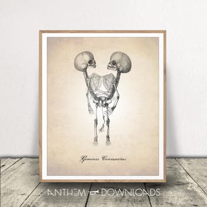 Conjoined Twins Art Print - Anatomy Drawing - Human Anatomy Download - Medical Drawing - Instant Download