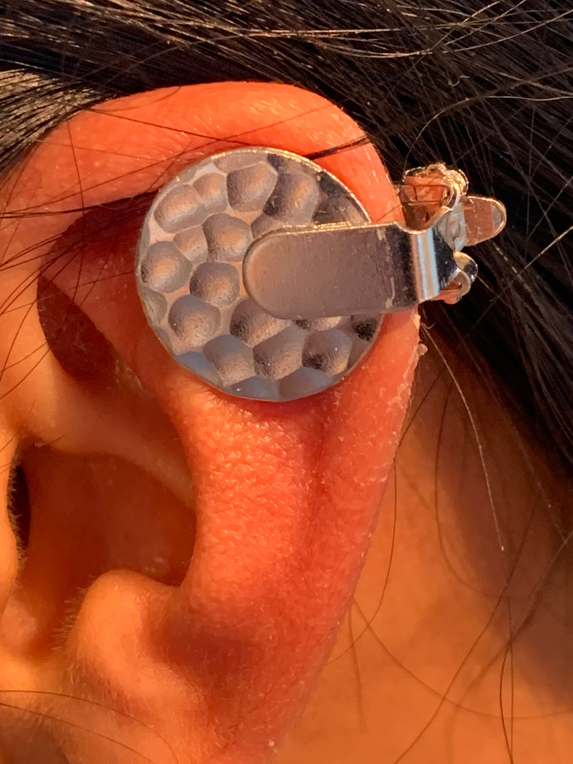 Ear Keloid Compression Plastic Discs Plastic Disc Earring for Post-op Keloid  Pressure'smiley' Shape 