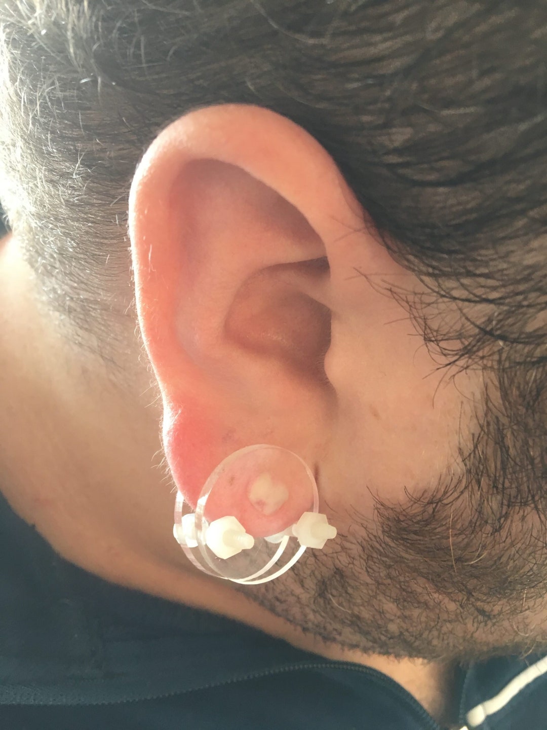 Amazoncom Hujiling Pressure Earring for Keloid Keloid Earrings Pressure  Clip Compression Earrings for Keloids Stainless Steel Spiral Nonpierced  Earrings Cartilage Helix Wrap Ear Jewelry Set Black Clothing Shoes   Jewelry