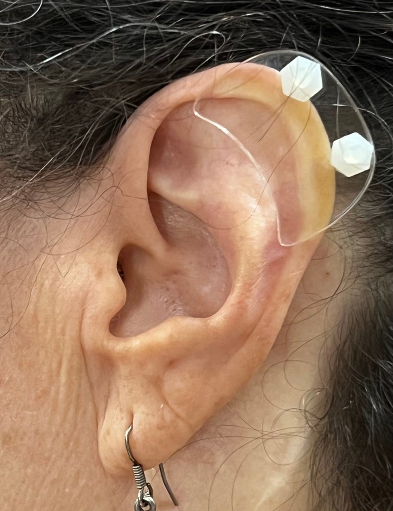 Ear Keloid Compression Plastic Discs Plastic disc earring for post-op keloid pressure'Smiley' shape image 2