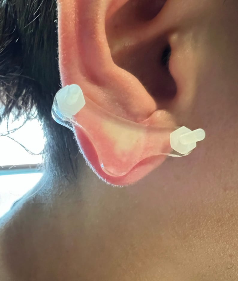 Ear Keloid Compression Plastic Discs Plastic disc earring for post-op keloid treatment model 'bikini' image 3