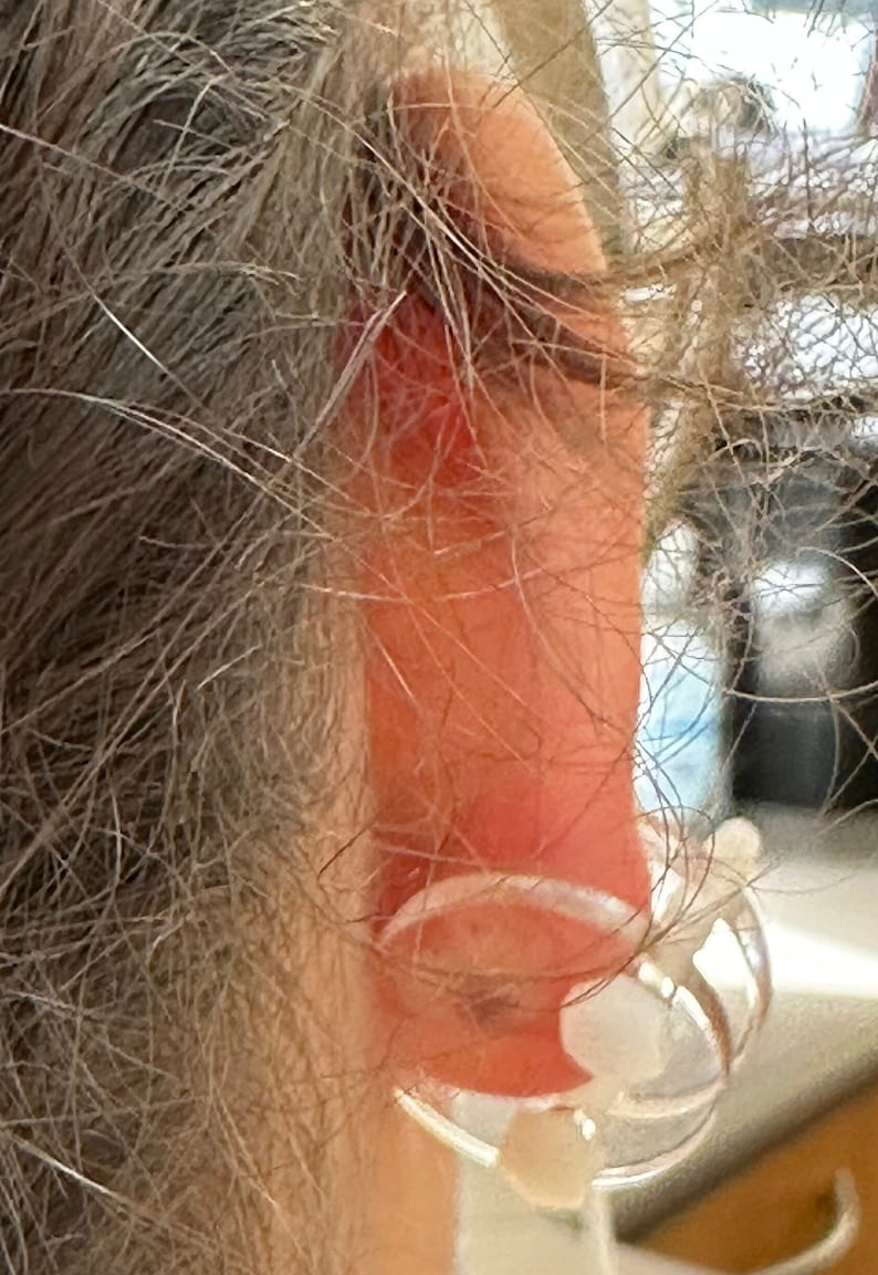 Ear Keloid Compression Plastic Discs Plastic disc earring for post-op keloid pressure model 2.3cm image 4