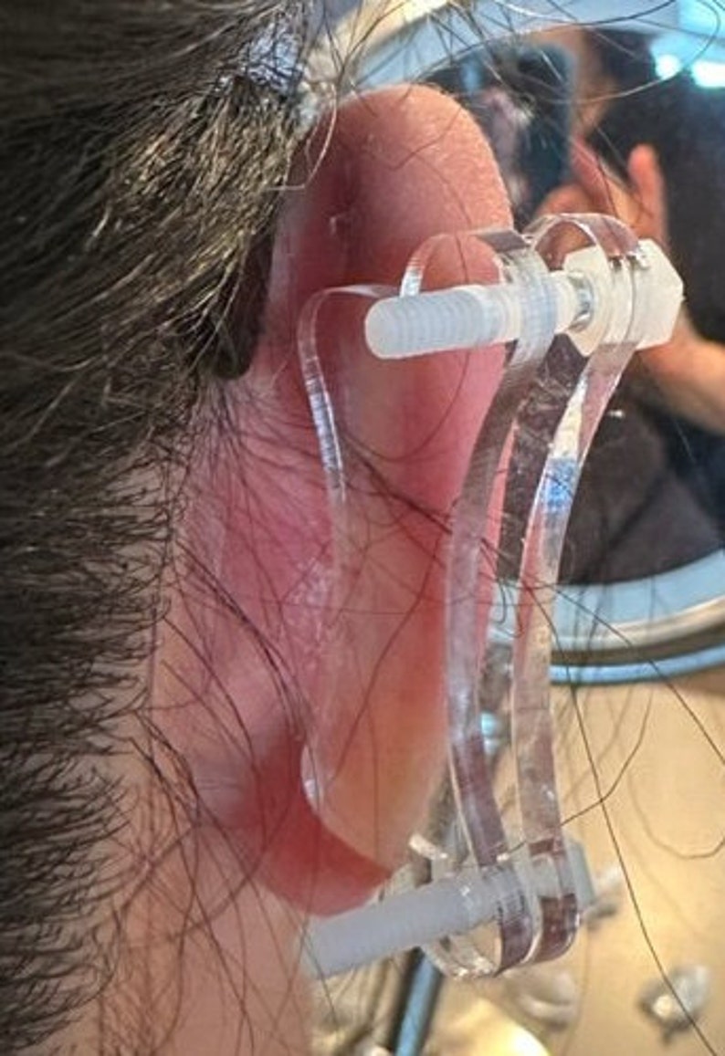 Discos de plástico de compresión para queloides en la oreja: arete de disco de plástico para presión queloide postoperatoria modelo 'Dogbone' imagen 6