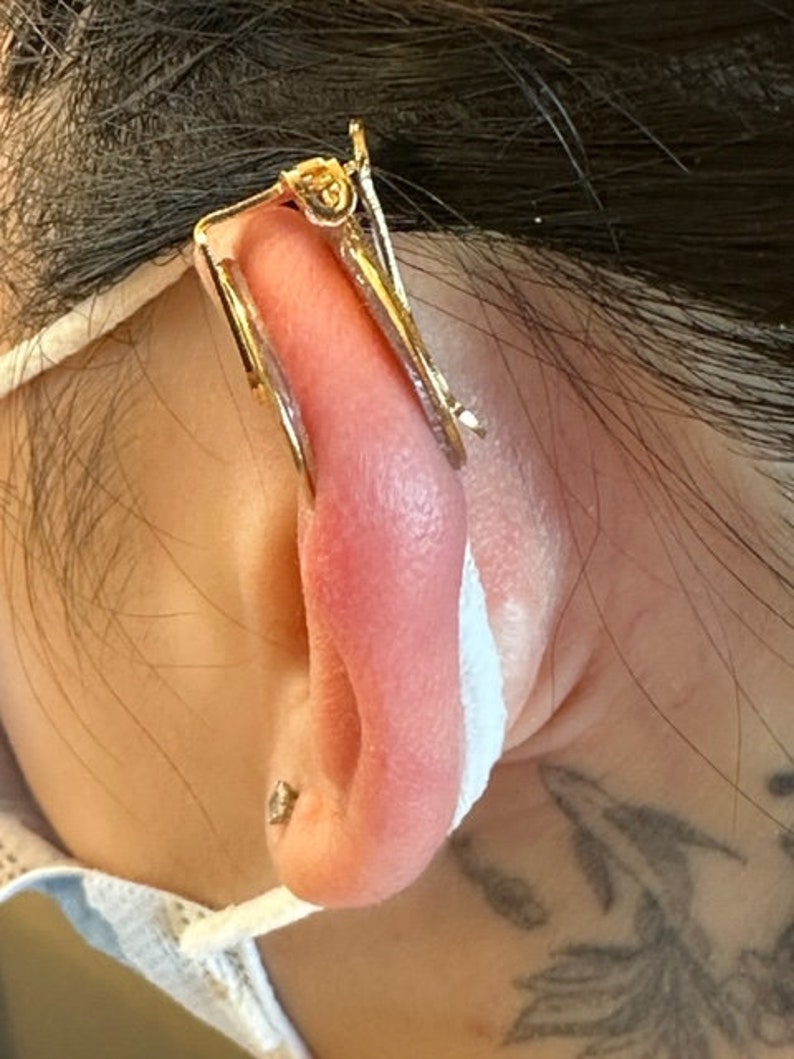 Clip per compressione dei cheloidi dell'orecchio Coppia di orecchini a clip per il trattamento dei cheloidi post-operatori immagine 9