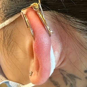 Clip di compressione dei cheloidi dell'orecchio: clip singola sull'orecchino per il trattamento dei cheloidi post-operatori immagine 10