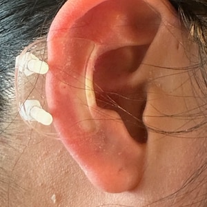 Ear Keloid Compression Plastic Discs Plastic disc earring for post-op keloid pressure'Smiley' shape image 6