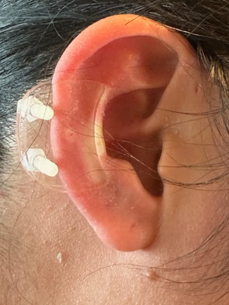 Ear Keloid Compression Plastic Discs Plastic disc earring for post-op keloid pressure'Smiley' shape image 6