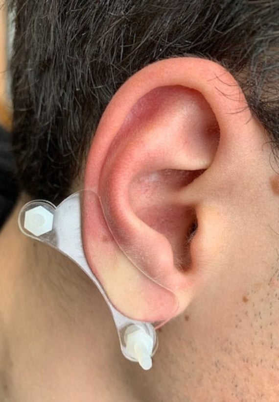 Ear Keloid Compression Clip Pair of Clip on Earrings for Post-op Keloid  Treatment -  Sweden