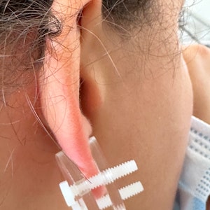 Disques en plastique pour compression chéloïde de l'oreille Boucle d'oreille en plastique pour pression chéloïde post-opératoire Modèle 2,3 cm image 5