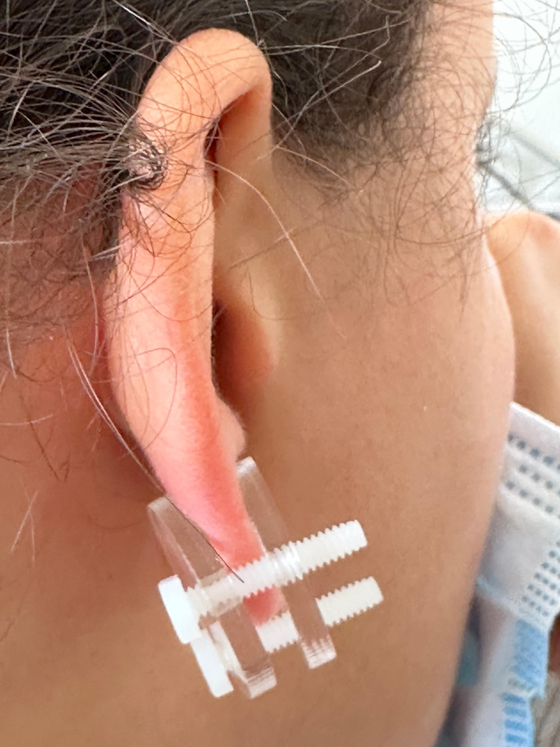 Ear Keloid Compression Plastic Discs Plastic Disc Earring for Post