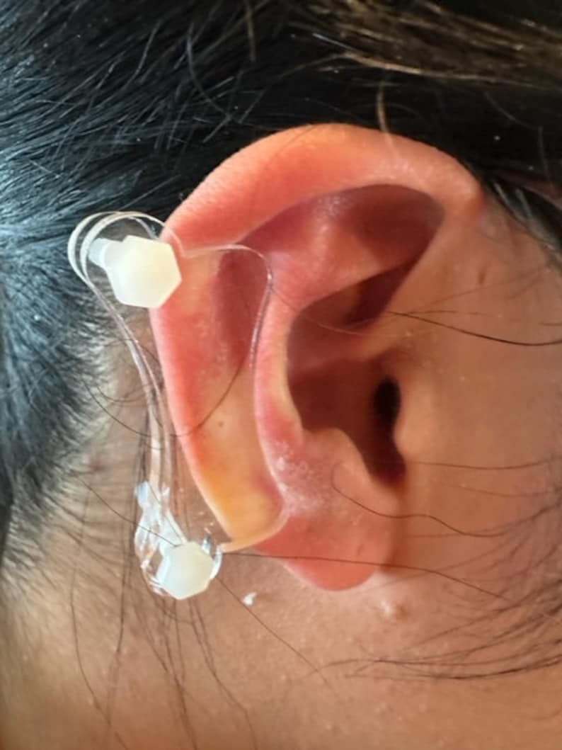 Ear Keloid Compression Plastic Discs Plastic disc earring for post-op keloid pressure model Dogbone imagem 5