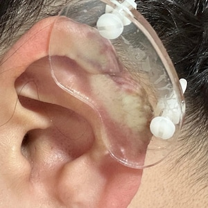 Disques en plastique pour compression chéloïde de l'oreille Boucle d'oreille en plastique pour pression chéloïde post-opératoire Forme haricot 3 tailles disponibles image 4