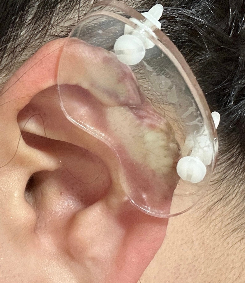 Disques en plastique pour compression chéloïde de l'oreille Boucle d'oreille en plastique pour pression chéloïde post-opératoire Forme haricot 3 tailles disponibles image 4